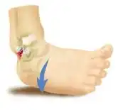 sprained ankle